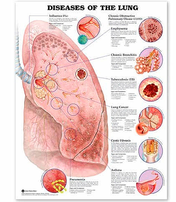Lung Diseases